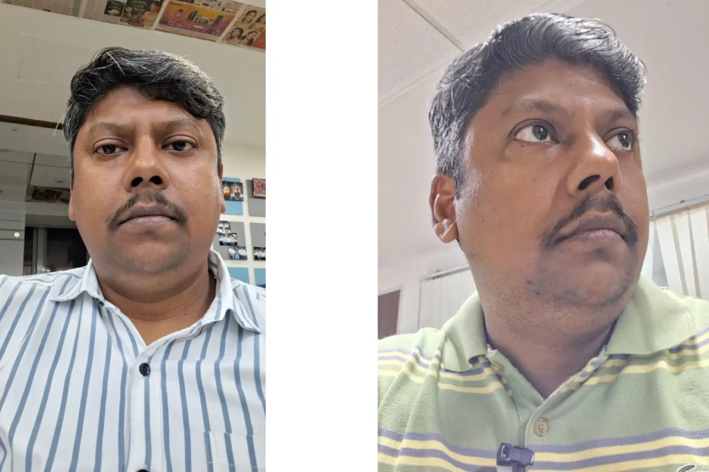 Vitiligo Treatment in Kolkata with Dr. Srijon Chatterjee